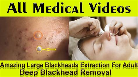 fat blackheads popping|removing huge blackheads videos.